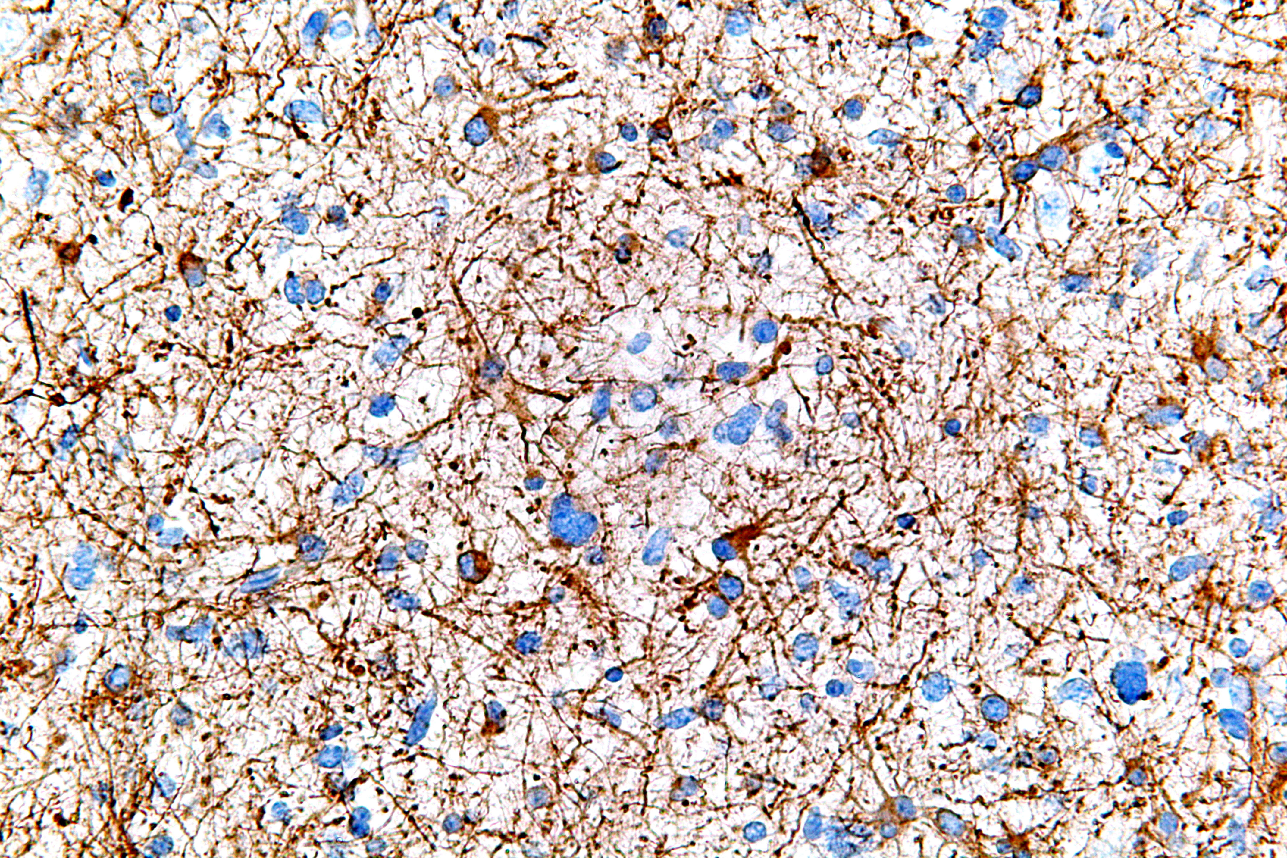 Anaplastic astrocytoma Glial fibrillary acidic protein process philosophy device language [source: https://commons.wikimedia.org/wiki/File:Anaplastic_astrocytoma_-_gfap_-_very_high_mag.jpg]